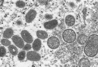 Kemenkes Yakin Cacar Monyet-Hepatitis Akut Tak Jadi Pandemi