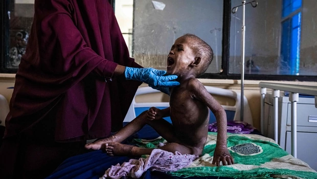 Ali Abdullahi Mohamed, bayi laki-laki berusia 27 bulan yang kekurangan gizi parah, diperiksa oleh perawat untuk dirawat di Rumah Sakit Bersalin dan Anak Banadir di Mogadishu, Somalia, pada rabu 1 Juni 2022.