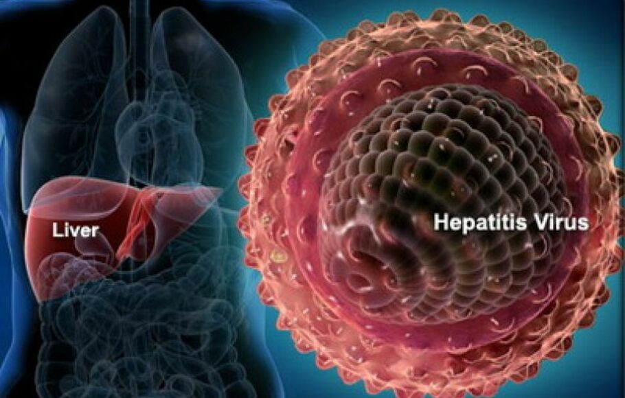 Ilustrasi penyakit hepatitis.
