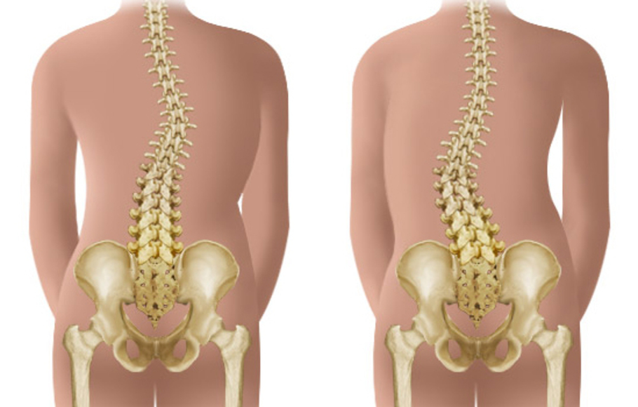 Tulang punggung yang membengkok ke arah kiri atau ke kanan disebut
