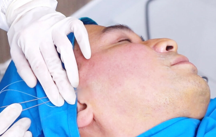 Dermaster Indonesia memperkenalkan treatment tarik benang Aptos sebagai salah satu inovasi metode perawatan wajah. 
