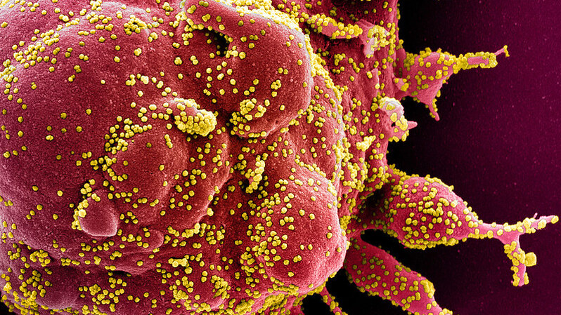 Institut Nasional Alergi dan Penyakit Menular (NIAID) dari National Institutes of Health (NIH), menunjukkan mikrograf elektron berwarna yang dipindai dari sel apoptosis (merah) yang sangat terinfeksi partikel-partikel virus SARS -COV-2 (kuning), dari sampel pasien yang diisolasi di Fasilitas Riset Terintegrasi (IRF) NIAID, di  Fort Detrick, Maryland, Amerika Serikat (AS). Komunitas intelijen AS telah menyimpulkan pada 30 April 2020, bahwa virus corona, yang telah menyapu dunia, berasal dari Tiongkok tetapi tidak dibuat oleh manusia atau direkayasa. ( Foto: HANDOUT / NATIONAL INSTITUTE OF ALLERGY AND INFECTIOUS DISEASES / AFP )